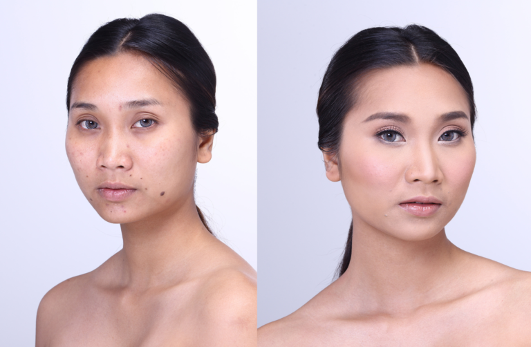 Winlevi Before and After: A Comprehensive Review of the Acne Treatment