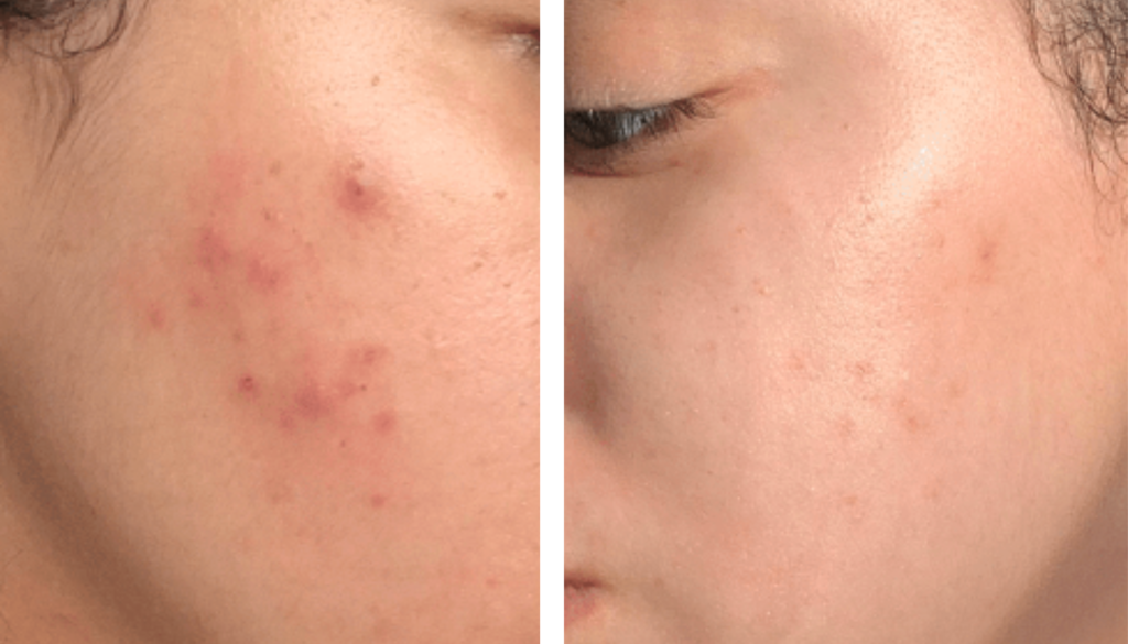 Epionce Lytic Gel Cleanser Before After